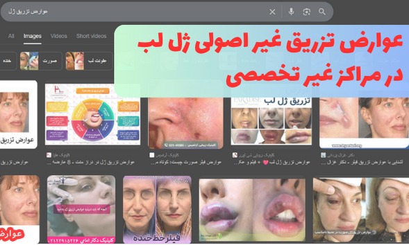 عوارض غیر اصولی تزریق ژل لب