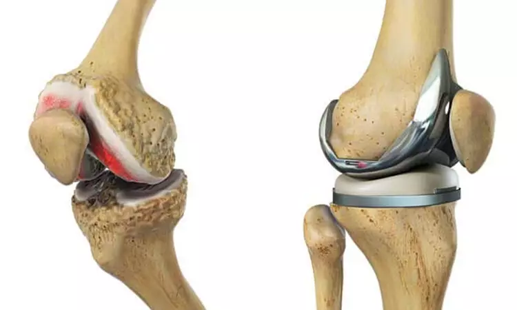 تعویض مفصل زانو و سلول‌درمانی SVF