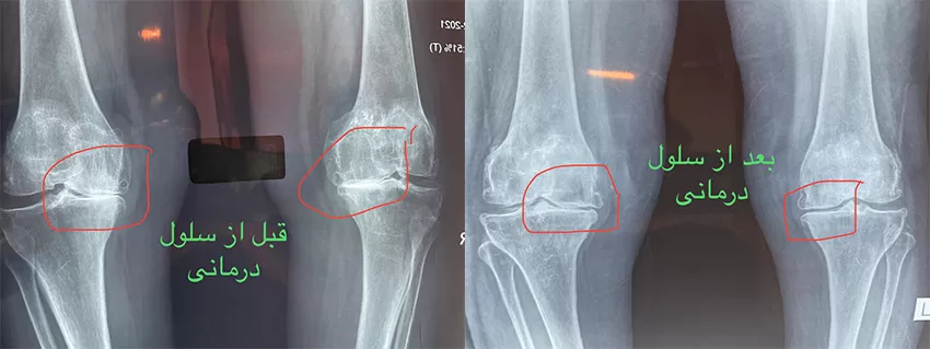 جراحی تعویض مفصل زانو