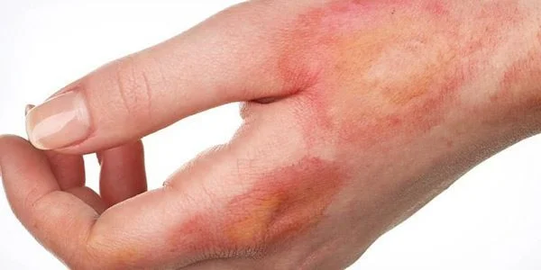 کلینیک سوختگی تهران