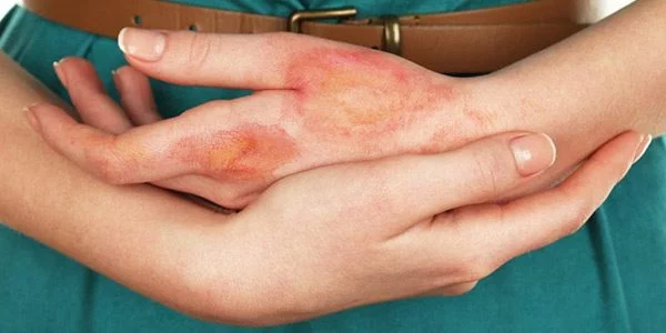 تکنولوژیهای نوین در درمان سوختگی