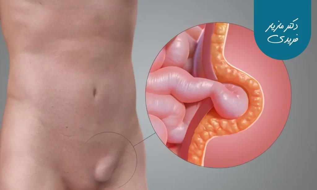 فتق چیست و چرا جراحی آن مهم است؟