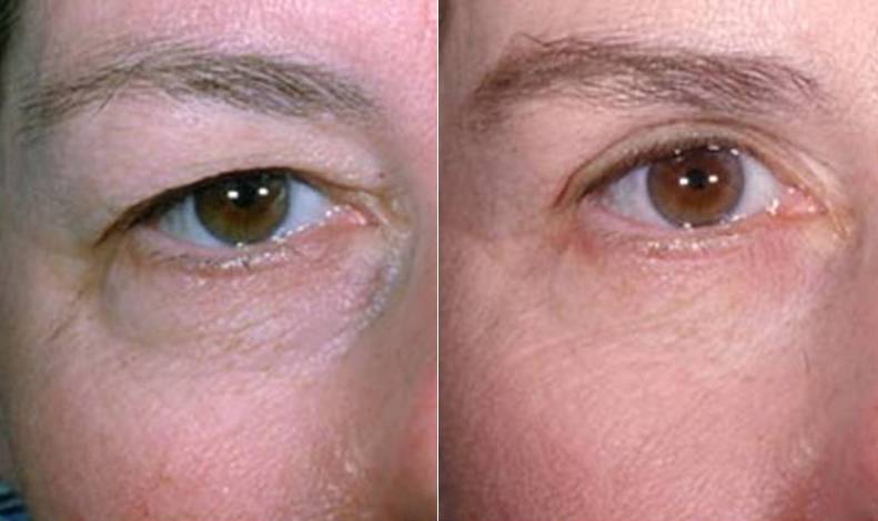 عمل جراحی زیبایی پلک