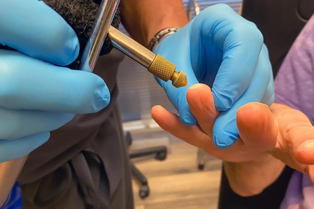 مرکز کرایوتراپی زگیل تناسلی در تهران