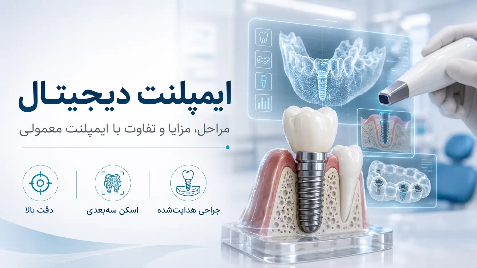 ایمپلنت دیجیتال