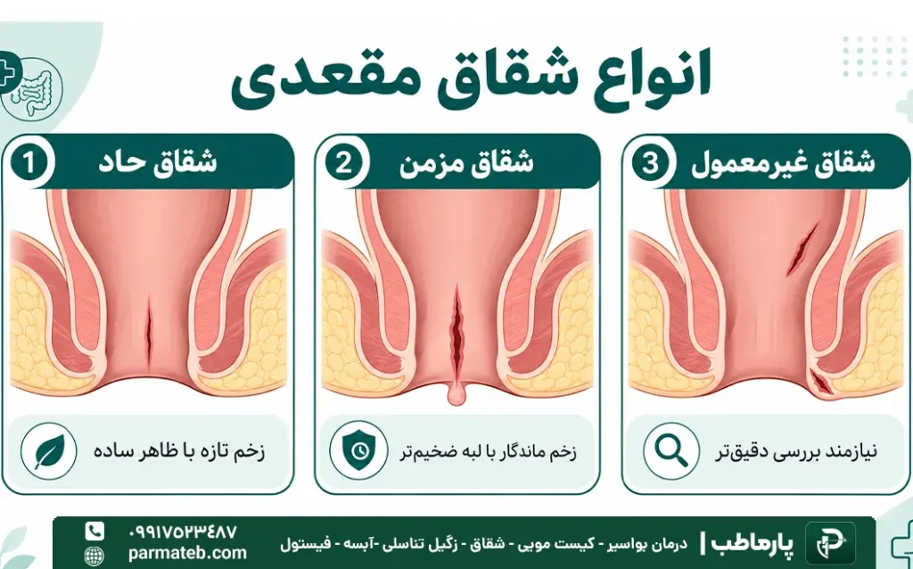 انواع شقاق مقعدی